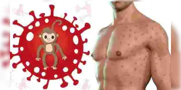Read more about - পরিবর্তন করা হচ্ছে মাঙ্কি পক্সের নাম, নতুন নাম এমপক্স হতে পারে, পরিকল্পনা বিশ্ব স্বাস্থ্য সংস্থার
