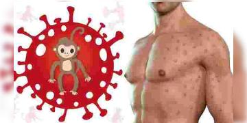 Read more about - পরিবর্তন করা হচ্ছে মাঙ্কি পক্সের নাম, নতুন নাম এমপক্স হতে পারে, পরিকল্পনা বিশ্ব স্বাস্থ্য সংস্থার