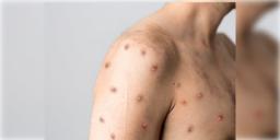 Read more about - Monkeypox | ভারতে এক ব্যক্তির মধ্যে পাওয়া গিয়েছে মাঙ্কিপক্স ভাইরাসের উপসর্গ, চিন্তায় স্বাস্থ্য দফতর