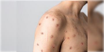 Read more about - Monkeypox | ভারতে এক ব্যক্তির মধ্যে পাওয়া গিয়েছে মাঙ্কিপক্স ভাইরাসের উপসর্গ, চিন্তায় স্বাস্থ্য দফতর