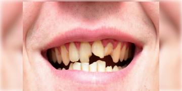 Read more about - দাঁত ও মাড়ির সমস্যা দূর করার উপায়, How to prevent teeth and gum problem in Bengali