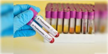 Read more about - HIV Infection | থ্যালাসেমিয়ার চিকিৎসায় রক্ত নিতে এসে HIV সংক্রমিত হলো পাঁচ শিশু! ঝাড়খণ্ডের সরকারি হাসপাতালে তোলপাড়