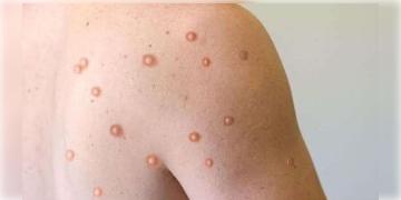 Read more about - ভারতে হানা দিয়েছে মাঙ্কিপক্স, এই রোগের প্রকোপ থেকে বাঁচতে  সরকার কী মেনে চলার পরামর্শ দিচ্ছে জানুন