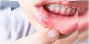 Read more about - Mouth Ulcer | মুখের ঘা নিমেষের মধ্যে ঠিক করুন ঘরোয়া পদ্ধতিতে!