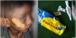 Read more about - Karnataka | শিশুর ফেটে যাওয়া থুতনি জুড়তে ফেভিকুইক লাগলেন নার্স! 'সেলাই করলে আজীবন দাগ থেকে যায়'! দিলেন অজুহাতও