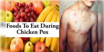 Read more about - Chicken Pox Diet | আবহাওয়ার পরিবর্তনে চিন্তা বাড়াচ্ছে চিকেন পক্স! জানুন দ্রুত সুস্থ্য হতে কী খাবেন?