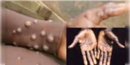 Read more about - Monkey Pox Hotspot: দক্ষিণী রাজ্যে মিলল দেশের দ্বিতীয় আক্রান্তের হদিশ!