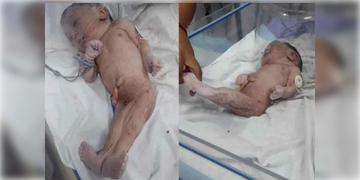 Read more about - Mermaid Baby | কাটোয়ায় জন্ম নিলো ‘মারমেড বেবি’! ৪ ঘন্টার মধ্যে চিরঘুমে ‘মৎস্যকন্যা শিশু’!