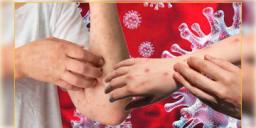 Read more about - Monkeypox | ভারতে মাঙ্কিপক্সে প্রথম আক্রান্তের হদিশ! ফিরে আসবে করোনার মতো পরিস্থিতি?