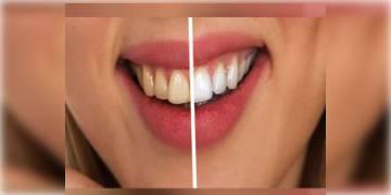 Read more about - ব্লিচ নয়, প্রাকৃতিক উপায়ে কিভাবে দাঁতের হলুদ ছোপ কমাবেন, আসুন জানা যাক