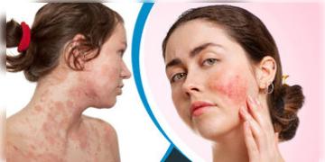 Read more about - গরমে ঘামাচির হাত থেকে মুক্তি পান কিছু ঘরোয়া পদ্ধতির সাহায্যে, Get rid of prickly heat during summer in Bengali