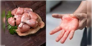 Read more about - Guillain Barre Syndrome | চিকেন খেলে হতে পারে গুলেন বেরি সিনড্রোম! সতর্ক করলেন বিজ্ঞানীরা!