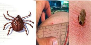 Read more about - CCHF । উকুনজাতীয় পরজীবীর মাধ্যমে পড়শী দেশে ছড়িয়ে পড়ছে ভয়াবহ ভাইরাস!এখনও পর্যন্ত এই রোগের নেই কোনও টিকা!