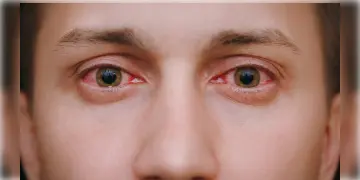 Read more about - Conjunctivitis | কনজাংটিভাইটিস আক্রান্তের দিকে তাকালেই কী আপনারও হতে পারে এই রোগ? জানুন কনজাংটিভাইটিস হওয়ার কারণ, চিকিৎসা!