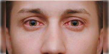 Read more about - Conjunctivitis | কনজাংটিভাইটিস আক্রান্তের দিকে তাকালেই কী আপনারও হতে পারে এই রোগ? জানুন কনজাংটিভাইটিস হওয়ার কারণ, চিকিৎসা!