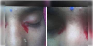 Read more about - 'ভাইক্যারিয়াস মেনস্ট্রুয়েশন', রজঃস্রাবের সময় এবার চোখ দিয়ে ঝরল রক্তের ধারা