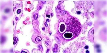 Read more about - চিন্তায় চিকিৎসকেরা, করোনা আক্রান্তদের শরীরে মিলছে সাইটোমেগালো ভাইরাস