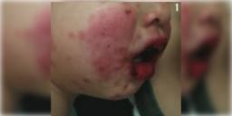 Read more about - Steven Johnson Syndrome | জ্বর এলেই প্যারাসিটামল খান? প্রাণঘাতী হতে পারে ট্যাবলেট! আতঙ্কের নাম ‘স্টিভেন জনসন’