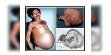 Read more about - Shocking: ৩৬ বছর ধরে তার ভাইয়ের ভিতরে বসবাস করেছিলেন তার যমজ