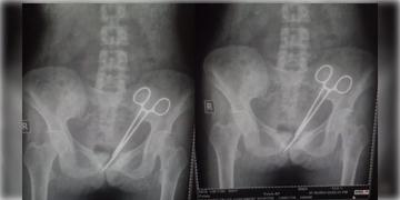 Read more about - Sikkim | ১২ বছর ধরে মহিলার পেটে সার্জিকাল কাঁচি! চিকিৎসকের গাফিলতিতে চরম ক্ষোভ