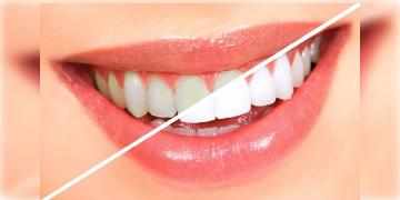 Read more about - World Oral Health Day | 'দাঁত থাকতে দাঁতের মর্ম' বুঝুন! জানুন কীভাবে নেবেন দাঁতের যত্ন? কীভাবেই বা দাঁত ঝকঝকে সাদা করবেন?