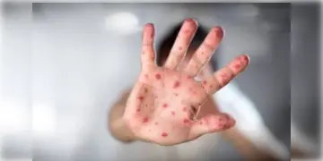 Read more about - MPox | মাঙ্কিপক্সে আক্রান্ত ১৪ হাজার! এখনও পর্যন্ত মৃত ৫২৪! এমপক্সের বাড়বাড়ন্ত নিয়ে উদ্বিগ্ন WHO