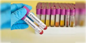 Read more about - HIV Infection | থ্যালাসেমিয়ার চিকিৎসায় রক্ত নিতে এসে HIV সংক্রমিত হলো পাঁচ শিশু! ঝাড়খণ্ডের সরকারি হাসপাতালে তোলপাড়
