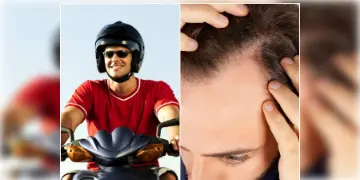 Read more about - Hair Fall Control Oil | রোজ হেলমেট পড়ার কারণে মাথায় পড়েছে টাক? জানুন কীভাবে গজাবেন নতুন চুল!