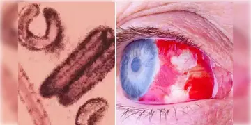 Read more about - Bleeding Eye Virus | ৫ দিনের মধ্যে ইন্টারন্যাল হ্যামারেজ, ৭ দিনের মধ্যে মৃত্যু! আতঙ্কের নয়া নাম ব্লিডিং আই ভাইরাস