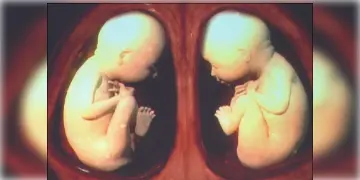 Read more about - Double Uterus Surgery: শান্তিপুরে বিরলতম অস্ত্রোপচার, জরায়ুর দুই প্রকোষ্ঠে দু’টি ভ্রূণ!