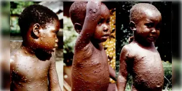 Read more about - Monkey Pox: সতর্কবার্তা বিশেষজ্ঞদের, যৌন মিলনেও ছড়াতে পারে মাঙ্কি ভাইরাস!