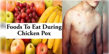 Read more about - Chicken Pox Diet | আবহাওয়ার পরিবর্তনে চিন্তা বাড়াচ্ছে চিকেন পক্স! জানুন দ্রুত সুস্থ্য হতে কী খাবেন?