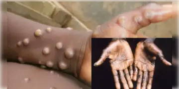 Read more about - Monkey Pox Hotspot: দক্ষিণী রাজ্যে মিলল দেশের দ্বিতীয় আক্রান্তের হদিশ!
