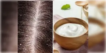 Read more about - Hair Mask for Dandruff | খুশকি কি ছোঁয়াচে? কীভাবেই বা তৈরী হয় খুশকি? জানুন খুশকি সম্পর্কে এবং কীভাবে বানাবেন খুশকির জন্য হেয়ার মাস্ক!
