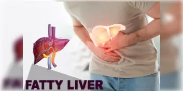 Read more about - Fatty Liver | কমবয়সীদের মধ্যে বাড়ছে ফ্যাটি লিভারের সম্ভাবনা! কীভাবে বুঝবেন আপনিও এই রোগের শিকার কি না?