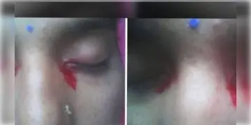 Read more about - 'ভাইক্যারিয়াস মেনস্ট্রুয়েশন', রজঃস্রাবের সময় এবার চোখ দিয়ে ঝরল রক্তের ধারা