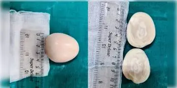 Read more about - বিরল দৃশ্য!  টিউমার ভেবে অস্ত্রোপচার করতে গিয়ে বেরোল আস্ত একটা সেদ্ধ ডিম।