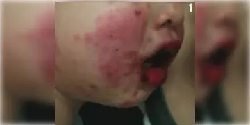 Read more about - Steven Johnson Syndrome | জ্বর এলেই প্যারাসিটামল খান? প্রাণঘাতী হতে পারে ট্যাবলেট! আতঙ্কের নাম ‘স্টিভেন জনসন’