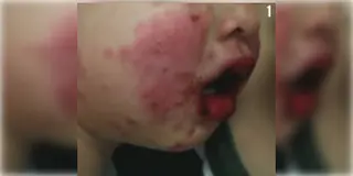 Read more about - Steven Johnson Syndrome | জ্বর এলেই প্যারাসিটামল খান? প্রাণঘাতী হতে পারে ট্যাবলেট! আতঙ্কের নাম ‘স্টিভেন জনসন’